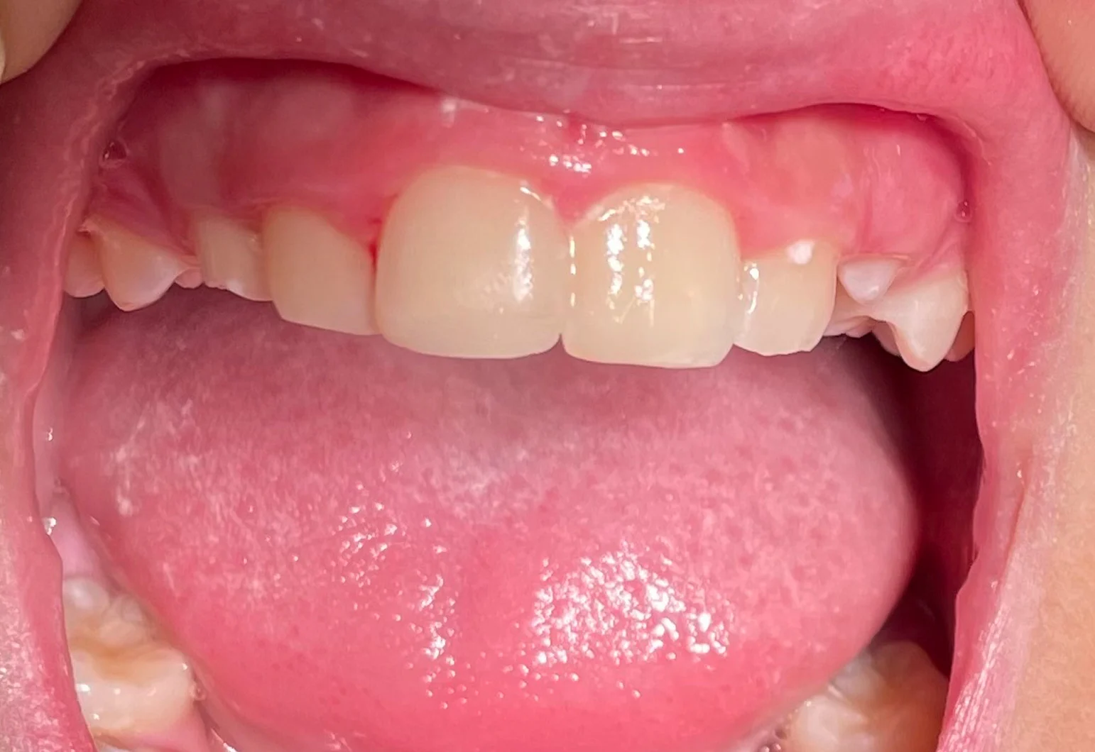 Antes de Antes y después — caso real de Traumatología Dental en la Clínica Dental Infantil de Toledo