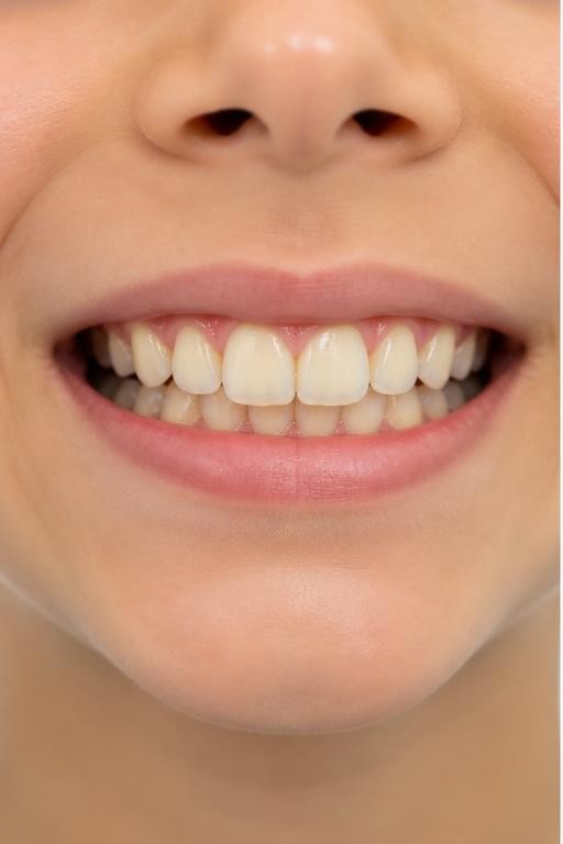 Antes de Blanqueamiento dental — Odontología Estética en la Clínica Dental Infantil de Toledo
