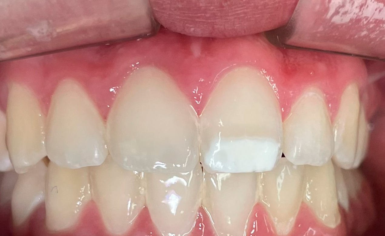 Antes de Carillas estéticas — Odontología Estética en la Clínica Dental Infantil de Toledo