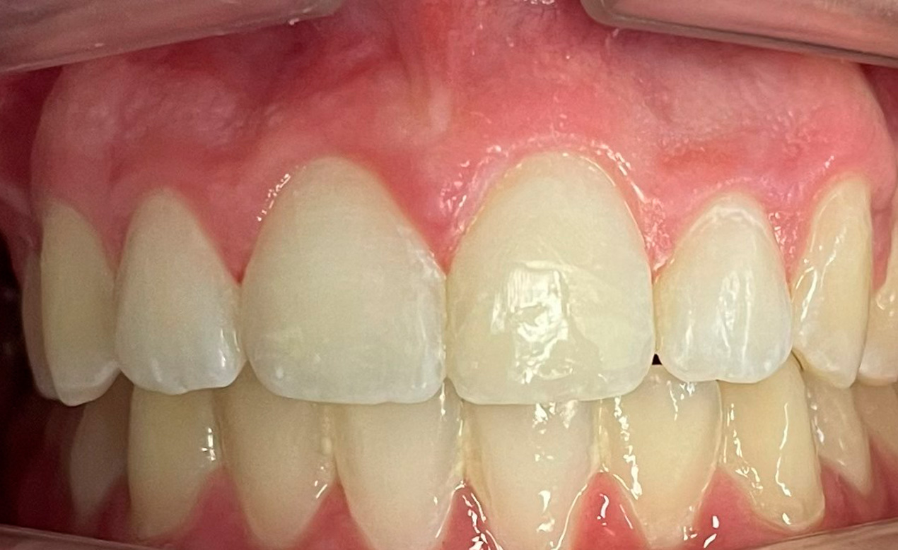 Después de Carillas estéticas — Odontología Estética en la Clínica Dental Infantil de Toledo