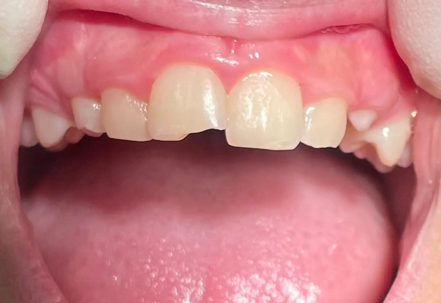 Después de Antes y después — caso real de Traumatología Dental en la Clínica Dental Infantil de Toledo